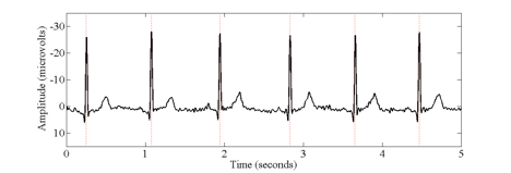 Example of electrocardiogram waveform.