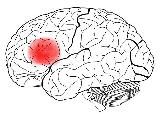 An illustration of the human brain with Broca's Area highlighted.