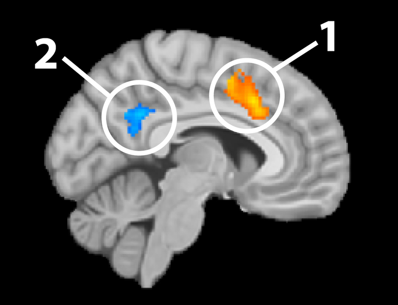 Example of fMRI analyses overlaid on an sMRI image.