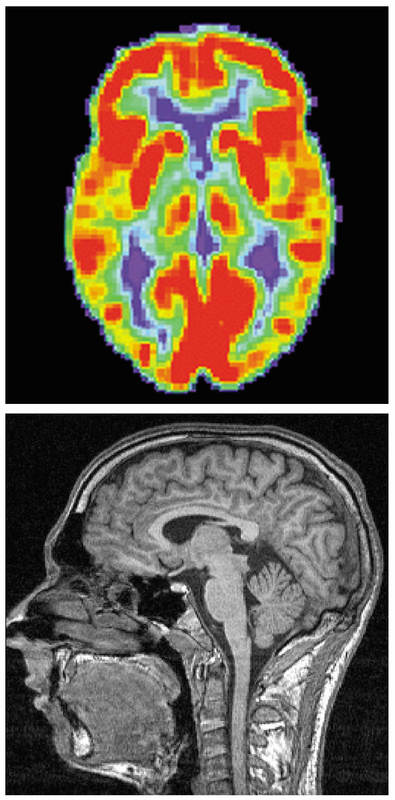  A PET scan of the human brain showing areas of red, green, blue, yellow, and purple: An fMRI of the human brain showing differing shades of gray.
