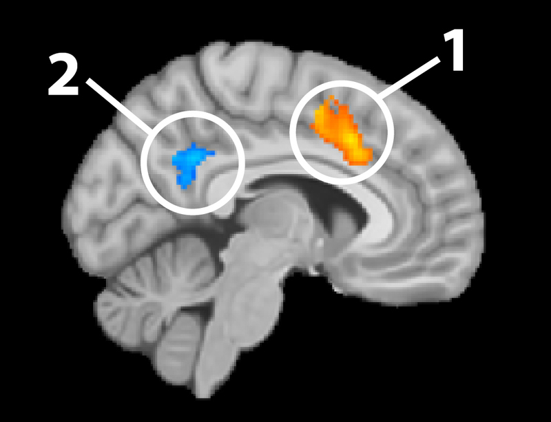 Ejemplo de análisis de fMRI superpuestos sobre una imagen de SMRI.