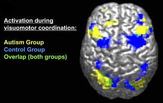 Imagen de diferencia derivada de FMRI entre cerebros de grupos autistas y control. La leyenda dice “Activación durante la coordinación visuomotora: Grupo de Autismo [amarillo], Grupo Control [Azul], Superposición (ambos grupos) [verde]”.