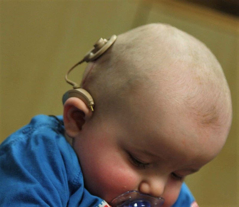 An infant with a cochlear implant.