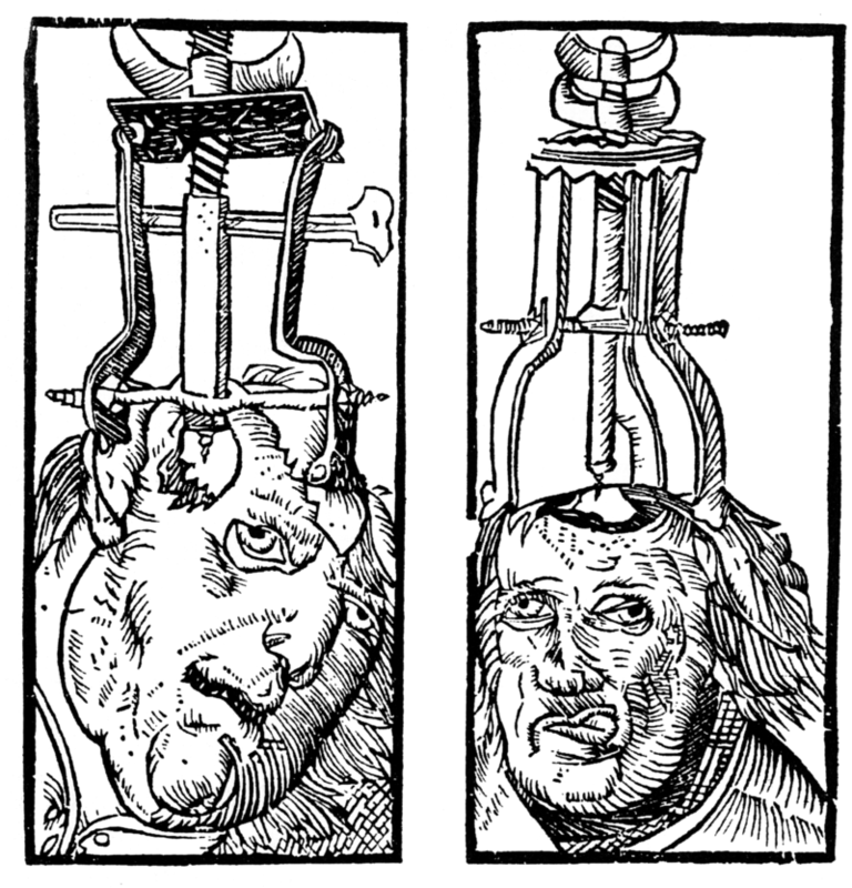 Grabado de Peter Treveris de una trepanación. Un tipo de taladro se sujeta a la cabeza y se utiliza para perforar un agujero a través del cráneo y exponer la duramadre.