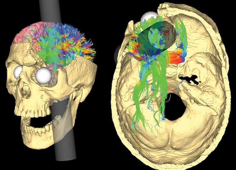 Modelo de cráneo que muestra el daño al cráneo y cerebro de Phineas Gage.