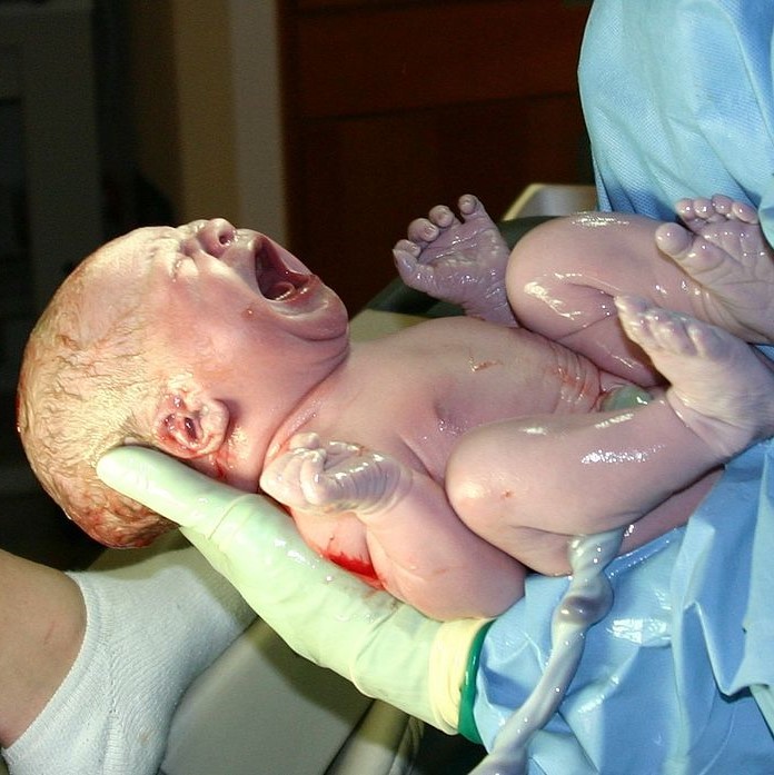 An infant, with umbilical cord still attached, is cradled in a nurse's arms shortly after birth.